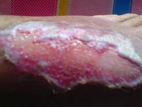 脚面烫伤图片,脚面烫伤紧急处理与康复指南