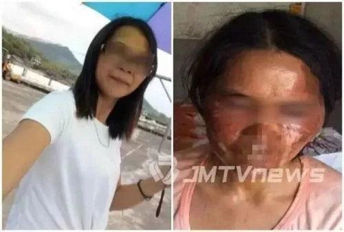 烫伤脸图片,面部烫伤紧急处理与康复护理指南